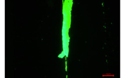 Iliac Venous Compression (May Thurner Syndrome)