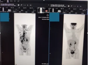 Split image showing before adjunctive therapy treatment, and 3 months after beginning treatment, demonstrating disappearance of extensive “black spots” seen all over patient's chest and lymph nodes in the neck. Remaining black areas in