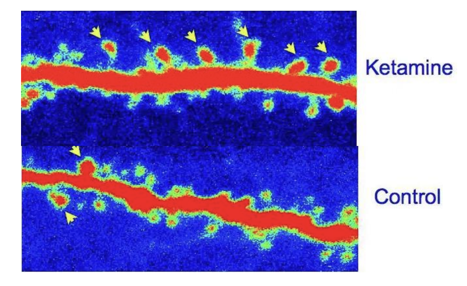 Neuronal Growth From Ketamine Treatment Image shows neuronal growth in a rat that underwent ketamine tratment, versus the lack of neuronal growth in a control group