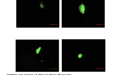 Microclotting in Long COVID and Post-Vaccine Syndrome: How Your Genetics Impact Treatment